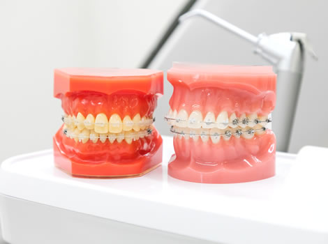 矯正で使う器具の種類について