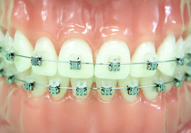 デーモンブラケット