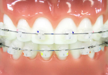 デーモンクリアブラケット