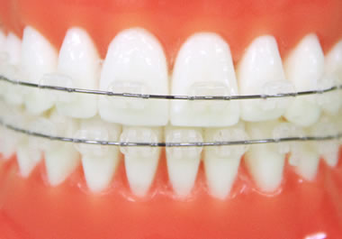 セラミックブラケット