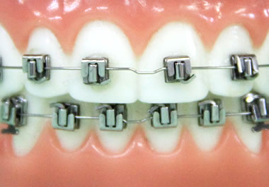 メタルブラケット